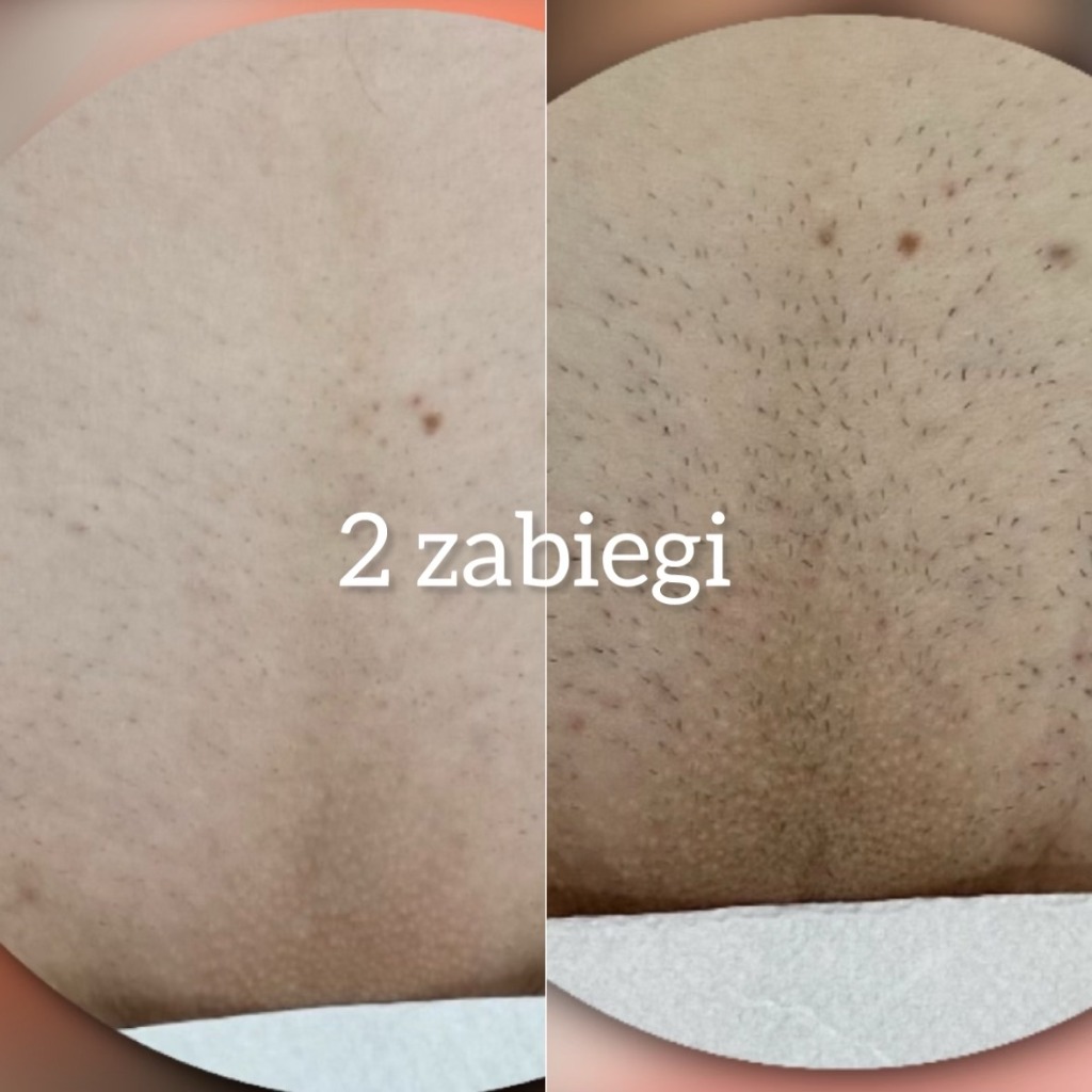 Efekt depilacji po 2 zabiegach