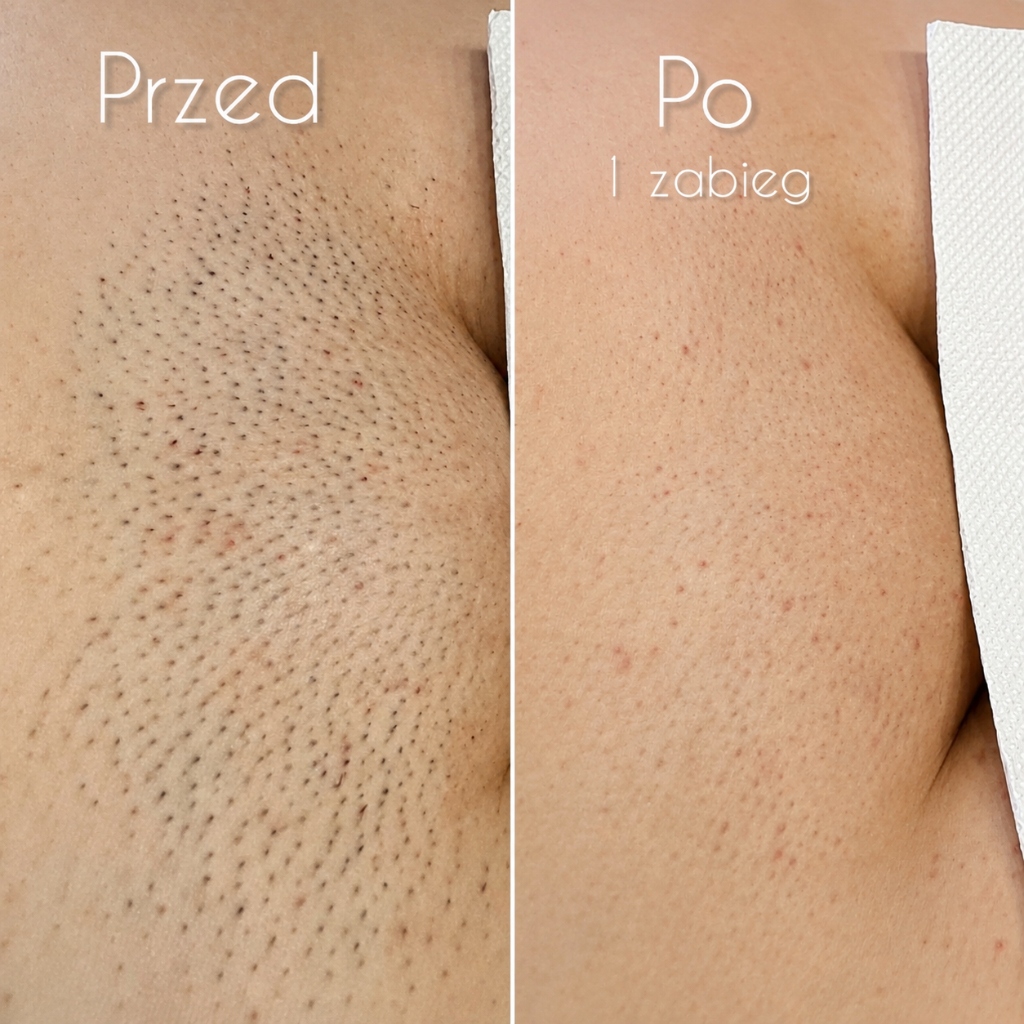 Efekt depilacji po 1 zabiegu