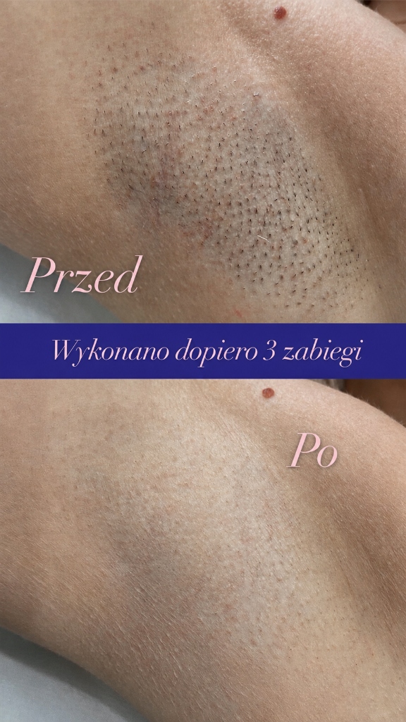 Wykonano dopiero 3 zabiegi